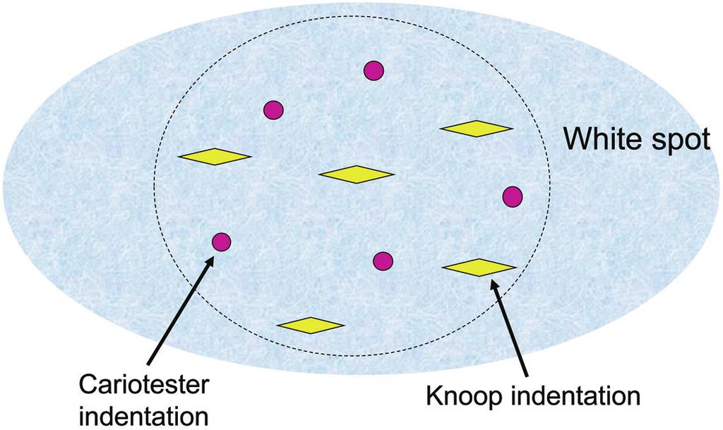 6 Schematic diagram showing Cariotester and Knoop indentations in a white spot region.