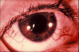 Ophthalmologic Signs of Genetic Neurological Disease ES ROACH,MD.