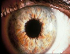 NF1: Eye Findings Hurler s (MPS I) Cockayne syndrome Mucolipidosis IV