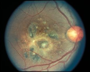 Von Hippel-Lindau Disease Retinal lesions in about 75% Nodular,