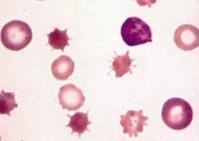 Etiology - Pseudoxanthoma elasticum - Sickle cell disease -