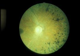 Retinitis Pigmentosa Caused by various hereditary retinal defects Degeneration of rod &