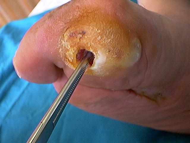 Diabetic foot osteomyelitis is a major risk factor for