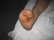 disturbances. Review: Diabetic foot infections: what have we learned in the last 30 years?