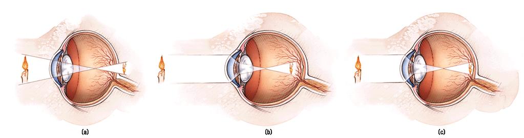 1. Accommodation- the process by which the eye s lens changes shape to help focus near or far objects on the retina 2. Acuity- the sharpness of vision 3.