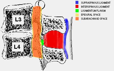Paravertebral Intra-spinous Subdural