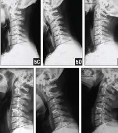 consistent with NDI scores Sagittal alignment of cervical spine, index level, and NDI improved significantly after