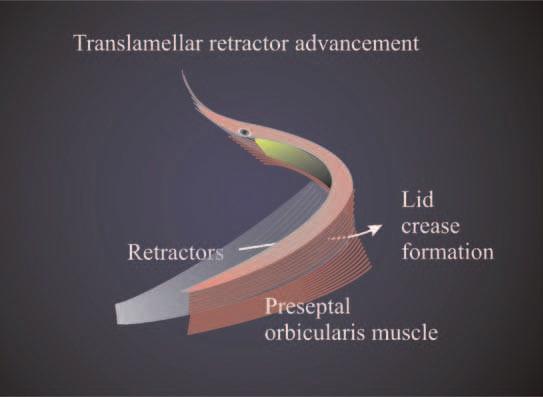 b A sagittal translamellar connection of the posterior and anterior lid lamellae is created to attach the orbicularis muscle and to restore the lower lid crease Fig.