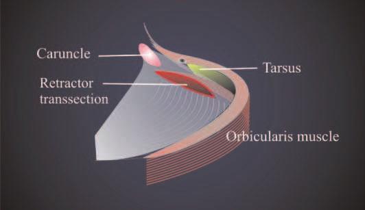 Principle of Retractor Fixation The action of the retractors is composed of a backward and a downward vector. In the center of the lower lid both vectors are equivalent.