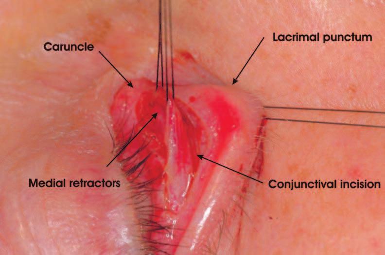 8 Repair of Involutional Ectropion and Entropion: Transconjunctival Surgery of the Lower Lid Retractors Fig.