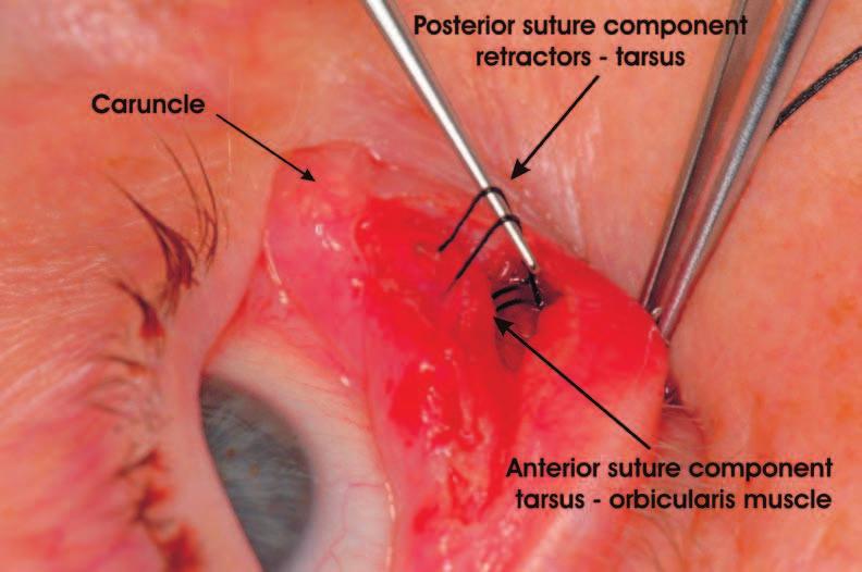 The medial lower lid retractors are exposed and grasped half way between the caruncle and the lacrimal punctum with a 6-0 non resorbable suture. Fig.