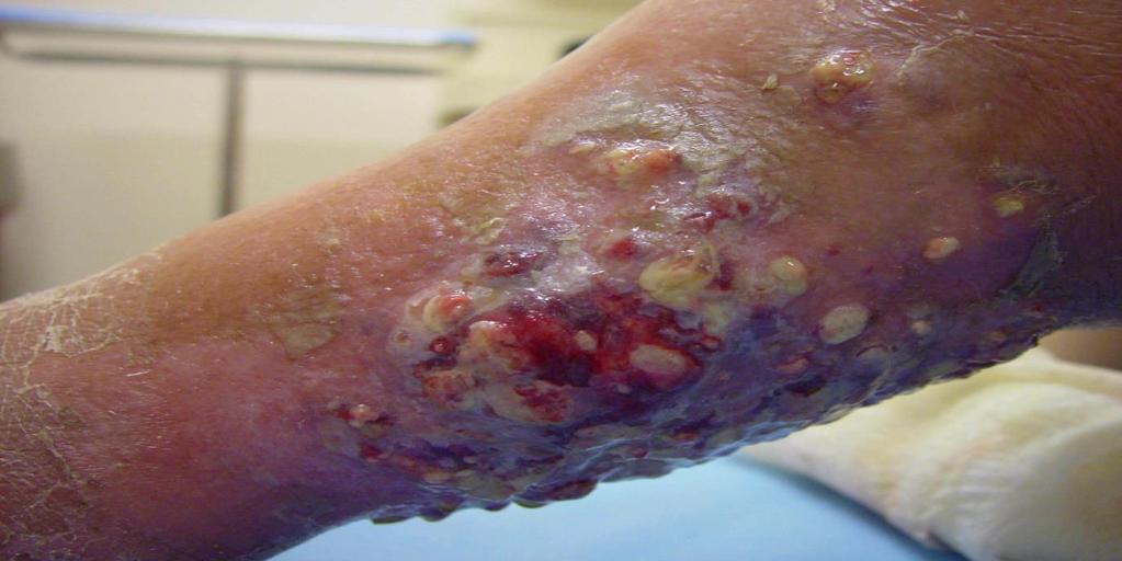 Mycetoma is a suppurative and granulomatous subcutaneous mycosis, which is destructive of contiguous bone, tendon, and skeletal muscle.