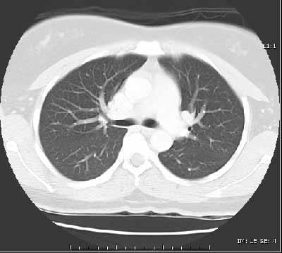 CT of the lungs, window level set to demonstrate the vessels and air ways - not intended to