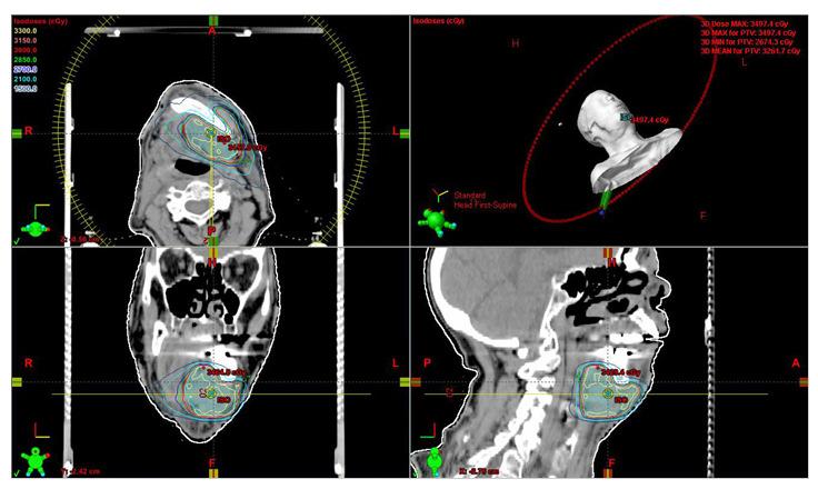 Intensity Modulated Arc Radiotherapy Courtesy of Varian Medical Systems IMRT Summary The inverse answer to dose conformation, for concave targets and OAR avoidance Multiple implementations: