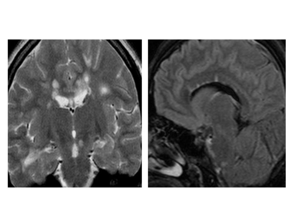 and cystic degeneration sparing gray matter. There is no contrast enhancement. [5] (Fig.3).