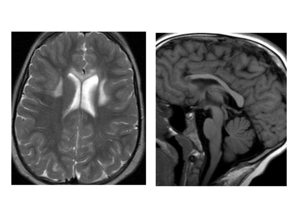 Fig. 1: Multiple sclerosis. Multifocal high signal intenities along the callososeptal interface characteristic sites of multiple sclerosis.