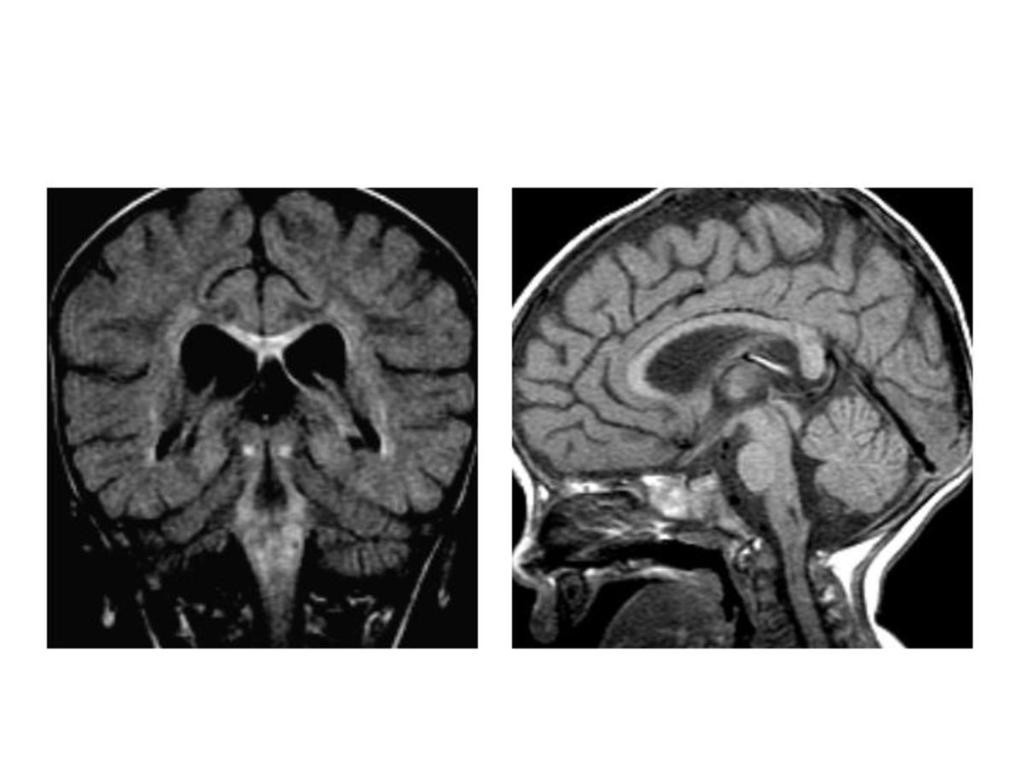 Fig. 6: Mitochondrial disease. Highi signal intensity of corpuc callosum and bilateral periventricular white matter on the coronal FLAIR image.