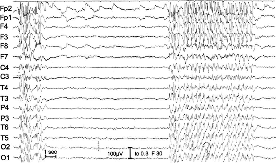 J. Larch, et al. Figure 2. Patient 2, 62 years, female. She had her first seizure at the age of 35 years, but had questionable absence seizures during childhood.