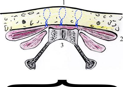 26 Aesth Plast Surg (2011) 35:24 30 Fig. 1 Medical illustration demonstrating the reported technique.