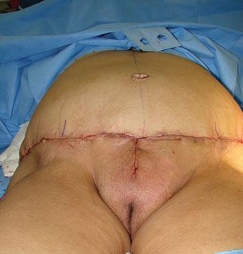 Aesth Plast Surg (2011) 35:24 30 27 excised before the fascial-dermal suspension sutures.