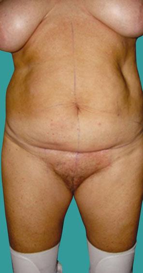 An abdominal pressure garment was applied immediately after skin closure and worn for 6 weeks.