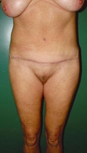 Results The classification and guidelines used to manage the deformities of the mons pubis were very helpful and achieved highly satisfactory outcomes.