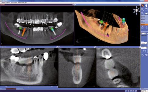 INDIVIDUAL CASE PLANNING takes place based on your specific needs always taking into account the pursued prosthetics. Merely a Conebeam dataset, created with a Sirona 3D-system, is required.