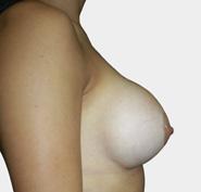 Motiva Implant Matrix Silicone Breast Implants Prospective Clinical