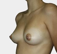 Implant Matrix Silicone Breast Implants within this prospective