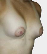 Motiva Implant Matrix Silicone Breast Implants Prospective Clinical Evaluation: 5-Year Follow-up Report Figure 5: Breast Augmentation with Motiva Implant Matrix 335 cc Full Projection, Subsequent