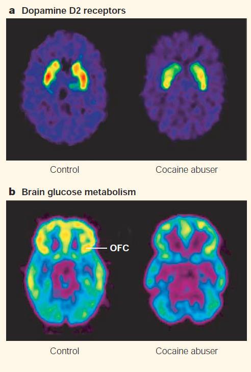 Imaging studies show frontal cortex changes in cocaine addicts PET scans done in control subjects and chronic cocaine users.