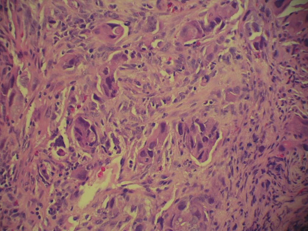 2 (d) Figure 1: Staining of transverse colon biopsy. H&E stain of transverse colon biopsy. Infiltrating poorly differentiated adenocarcinoma between normal colon glands.