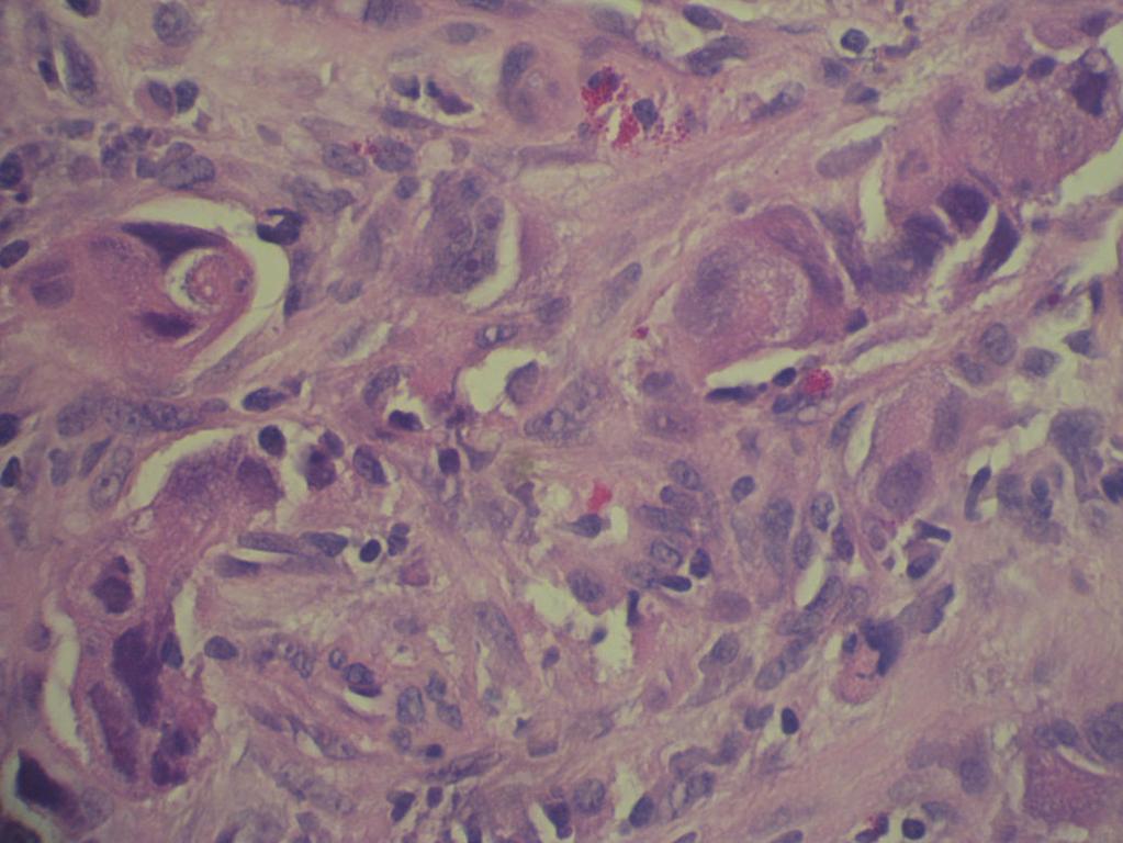 was positive for cytokeratin AE1/AE3, TTF-1, and CK7 (Figure 1). This constellation favors a tissue diagnosis of lung adenocarcinoma.