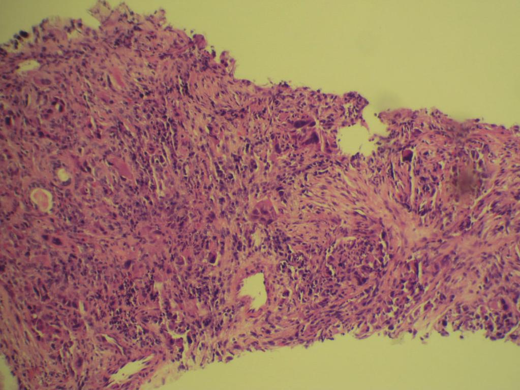 3 (d) Figure 2: Needle core biopsy of left upper lung lobe mass.,, and H&E stain demonstrating infiltrating adenocarcinoma.