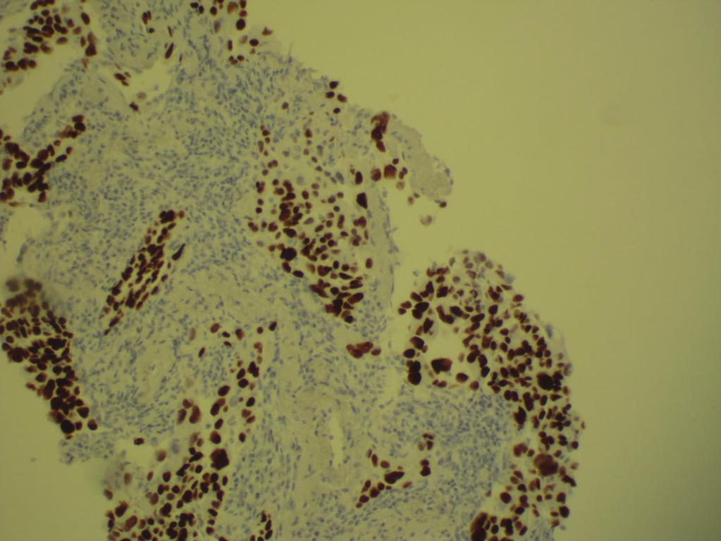 This mass was not biopsied and was assumed to be secondary to the primary adenocarcinoma in the left lung.