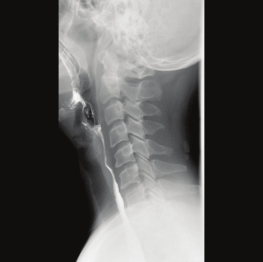 stomach. Normal X-rays of the abdomen may not show the gullet, stomach and intestines very clearly.