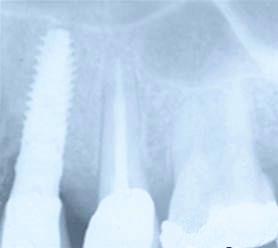 bone regeneration for implant placement 8