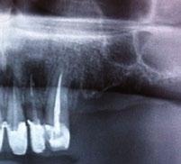 implant 2 years: perfect bone maturation