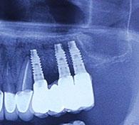 the placement of three implants 2 years: