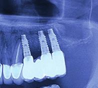 the placement of three implants 2 years: