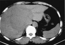 148 Sclerosing hepatocellular carcinoma 1a 1b 1c Figure 1. Dynamic CT scan: a.