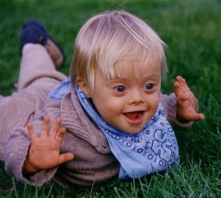 Down Syndrome Caused by non-disjunction of the 21 st chromosome.