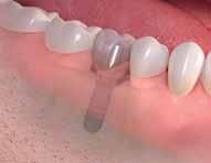 Straumann Dental Implants Treatment options.