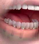 by 4 6 dental implants. These implants provide secure and lasting support for the bridge and your new teeth.