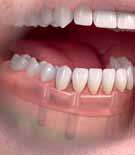 The implants act as an anchor for retentive components that attach to the denture, and while there are several different