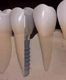 Dental implants: a proven, reliable and modern approach.