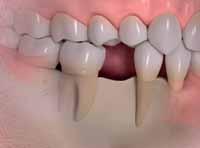 3, 4) under conventional restorations, such as bridges or partial prostheses.