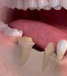 Conventional crown & bridge solution: With conventional methods, two neighboring teeth must be ground down in order to place a bridge.