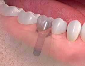 The implant solution: The dental implant replaces the root of