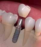 4 6: Tooth replacement with a dental implant and artificial